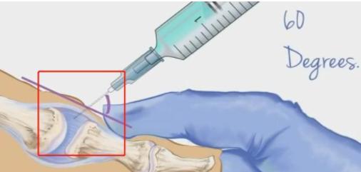 关节封闭针怎么打,关节疼打封闭针视频