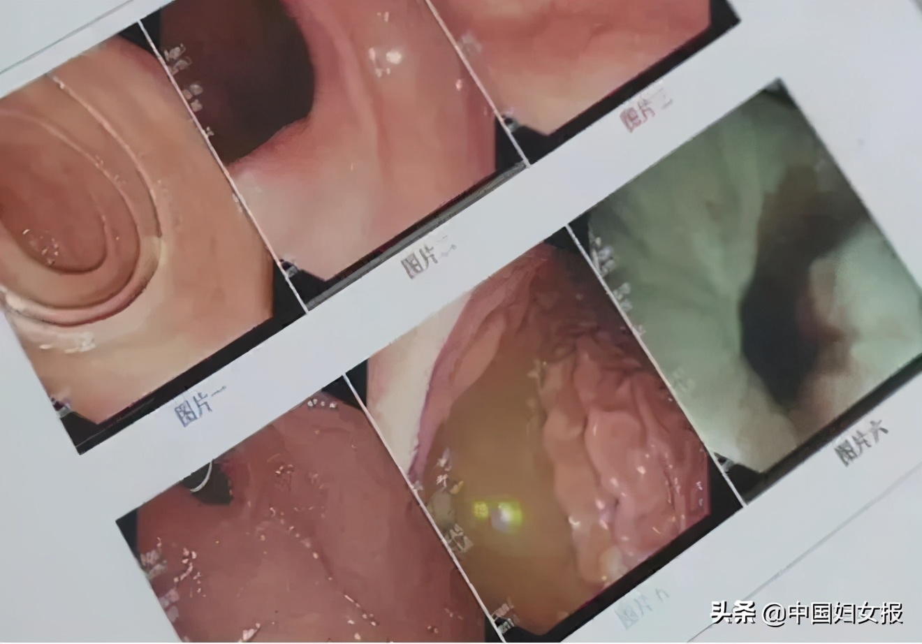 食用板栗胃出血的原因,板栗吃多了胃里烧得慌怎么办