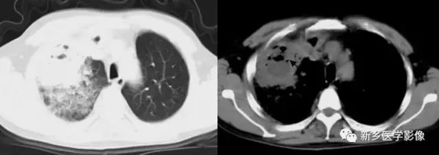 肺部基础免疫,肺基础疾病有哪些