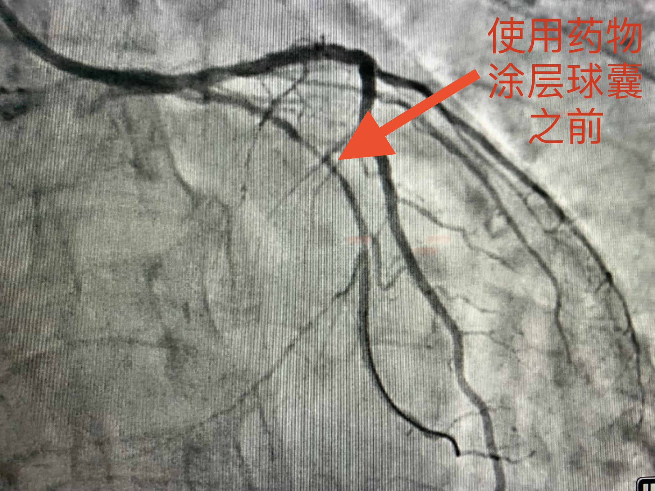 冠心病能否不用支架用中药调理,冠心病做支架好还是保守治疗好