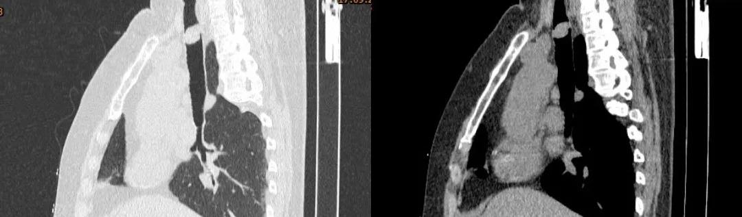 儿童90%为良性，成人却不到10%？患者气短3年，胸部CT提示的气管肿物意味着什么？气管镜有何发现？