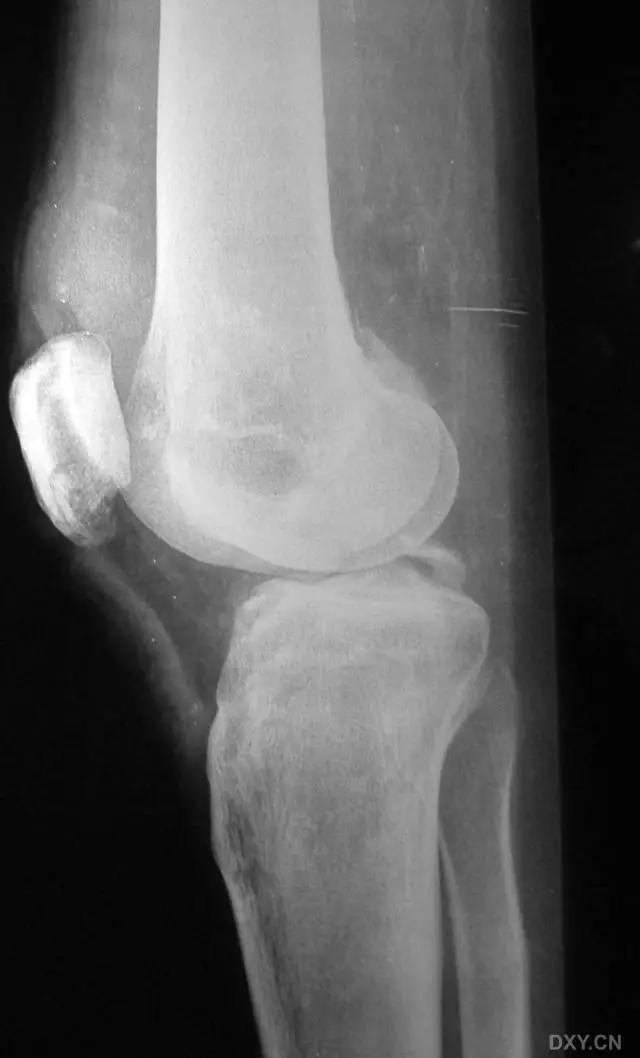 所有骨折都叫什么名字,骨折的名称有哪些