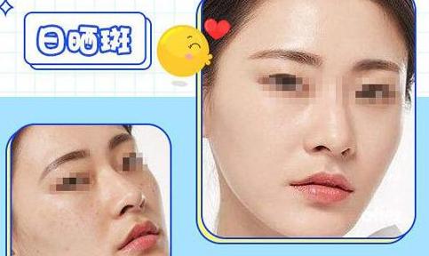 明星超皮秒祛斑,明星皮秒祛斑完整视频