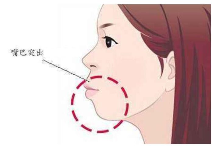 “龅牙”是深覆颌还是深覆盖，两者如何区分？还能不能治疗？