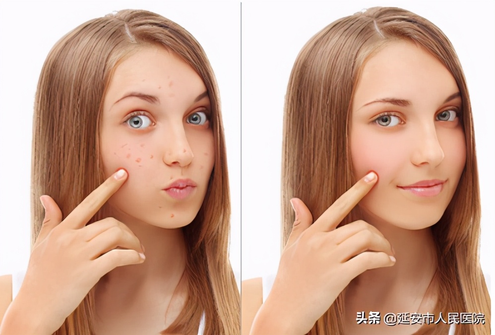 痒到怀疑人生的湿疹，到底该怎么办？