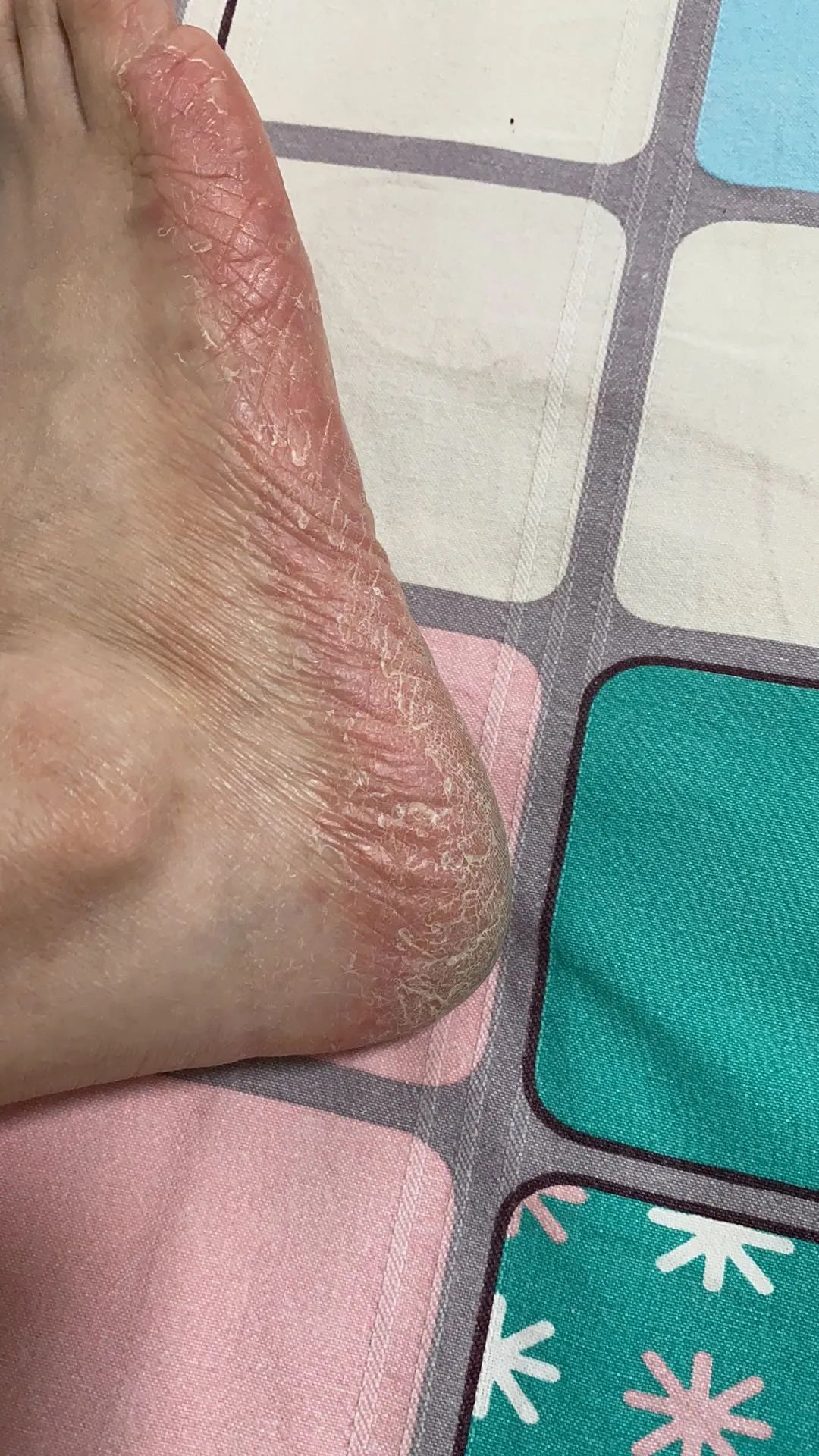 及时治疗脚气，是对家人最好的负责