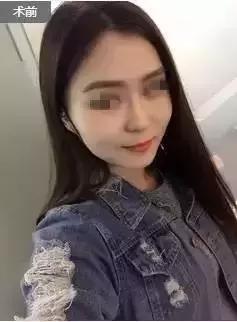 解密瘦脸针的几大常识性问题,关于瘦脸针的真实事件