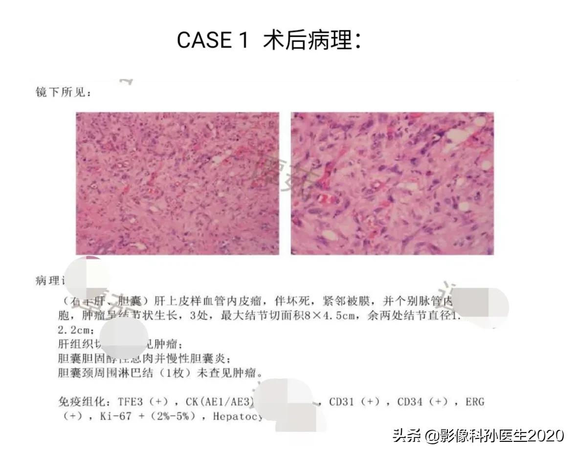 肝上皮样血管内皮瘤全国多少例,肝上皮样血管内皮瘤超声表现