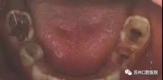 乳牙蛀牙清除真实全过程,小儿乳牙龋齿民间治疗偏方