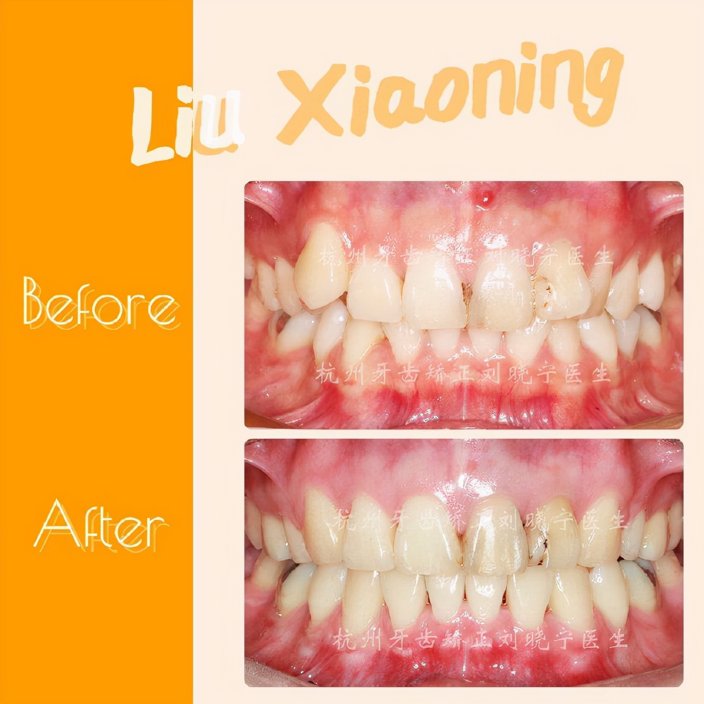 杭州舌侧牙齿矫正,舌侧矫正杭州价格