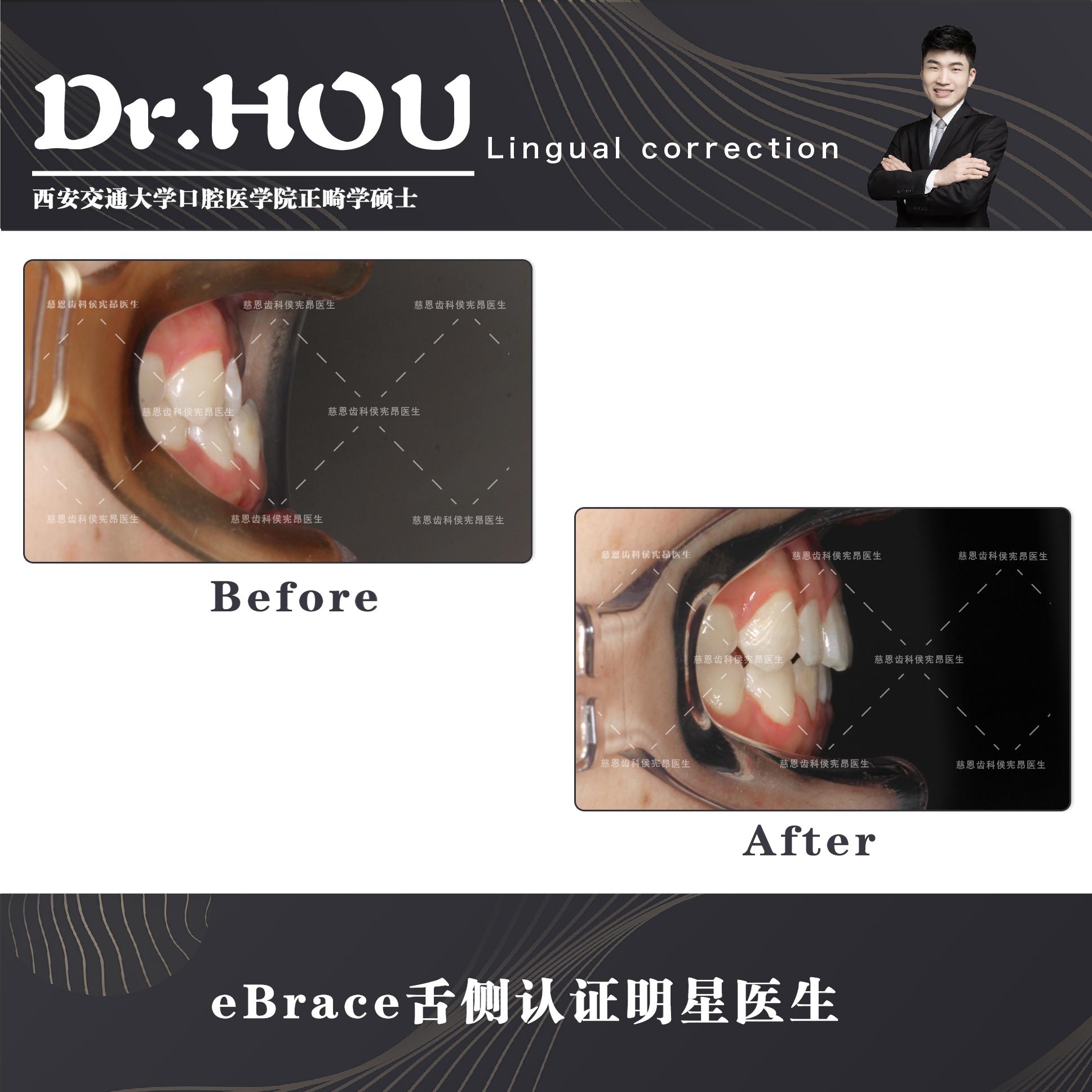 地包天的牙齿图片,牙齿地包天怎么补救