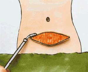 剖宫产疤痕增生用什么药膏能祛疤,剖宫产疤痕又疼又痒怎么办