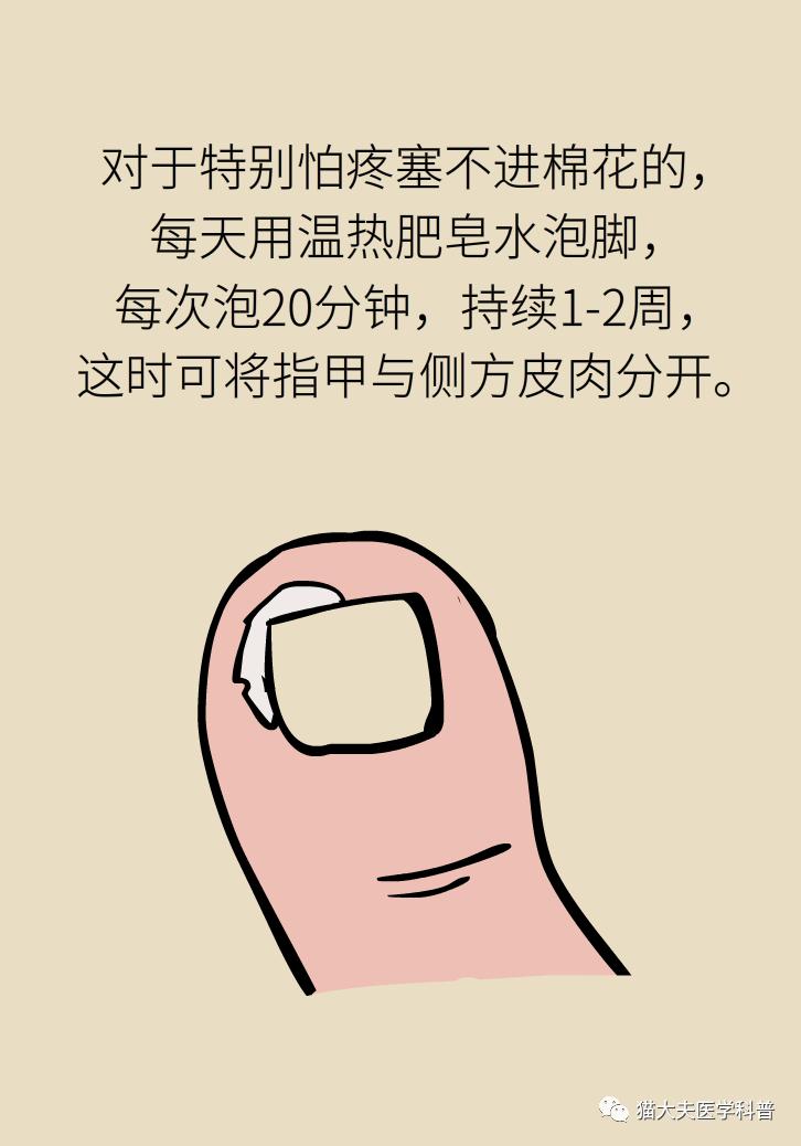 脚趾甲往肉里长怎么治除根,脚趾甲长在肉里面治疗视频