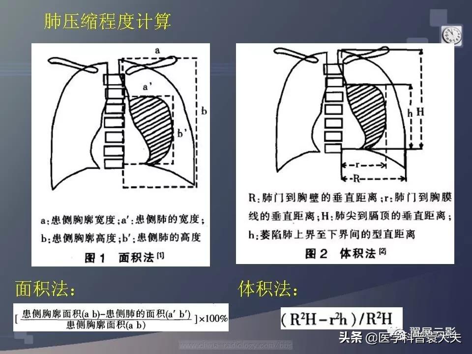 气胸在ct怎么诊断肺压缩,气胸单侧肺压缩多少是手术指征