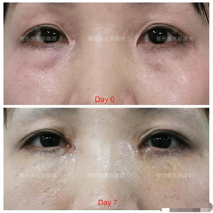 去眼袋泪沟医美方法,想了解一下去眼袋的最佳方法