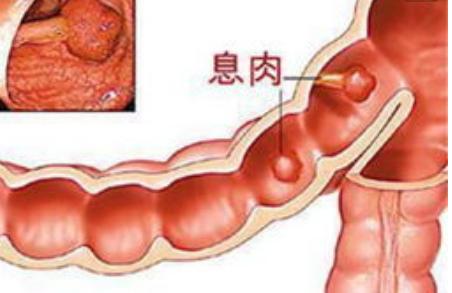 沈阳中医调理肠息肉不复发,肠息肉术后需要中药调理吗