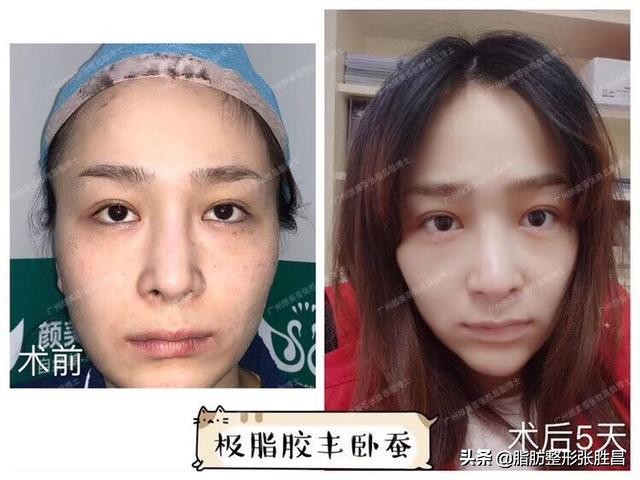 极脂胶丰卧蚕｜这“蚕宝宝”好神奇，从此我也有一双会笑的眼睛了