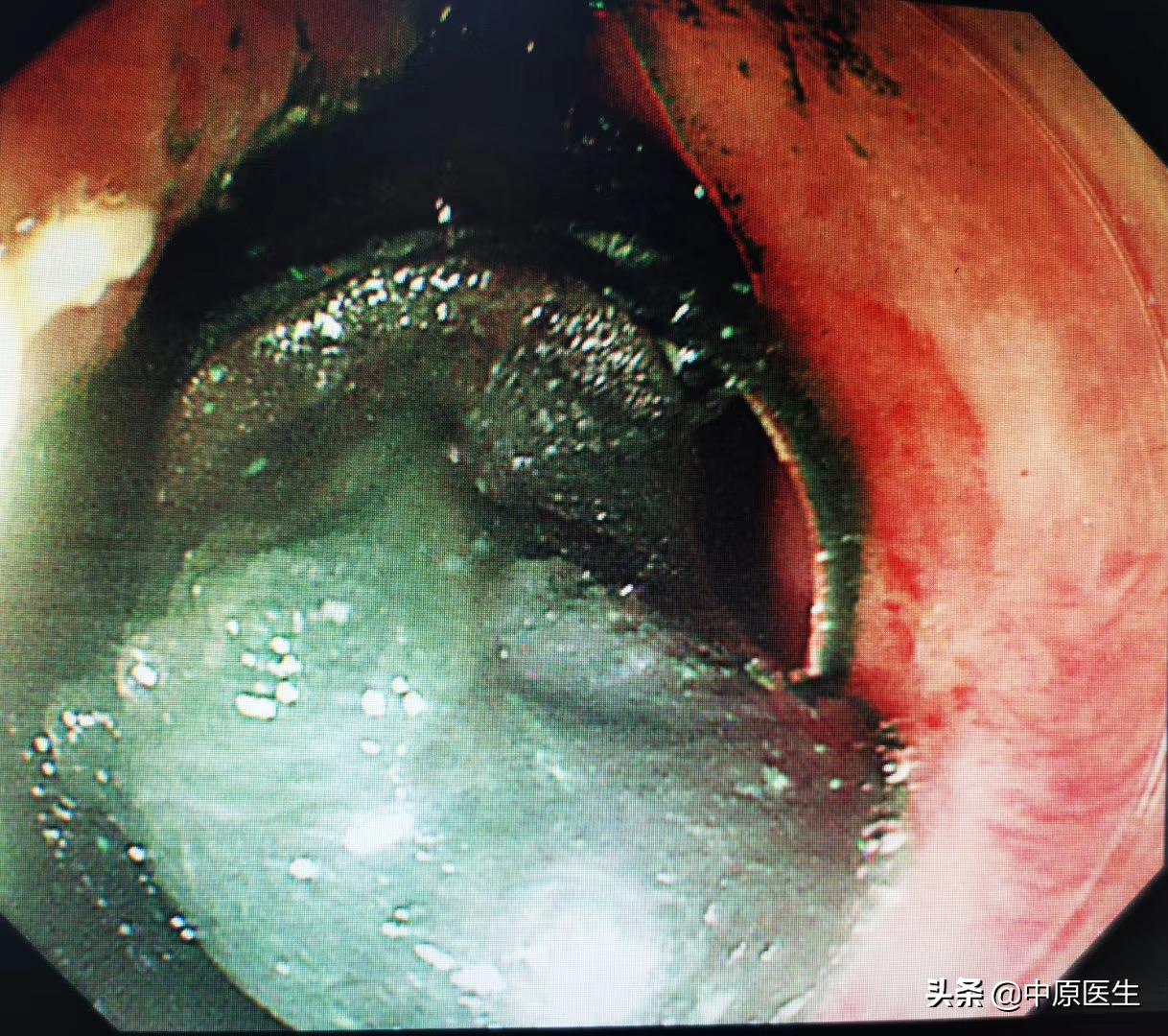 老人吃饭被骨头卡喉咙用什么药,老人被一粒饭卡喉咙