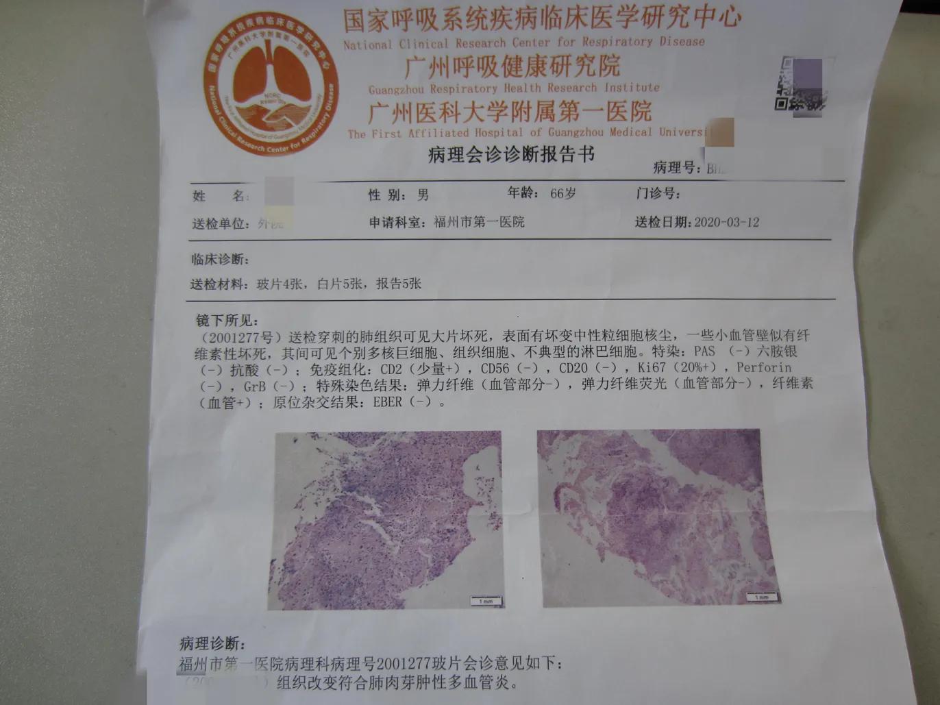 和肺癌比较像的肿瘤,和肺癌一样的肺炎是哪种肺炎