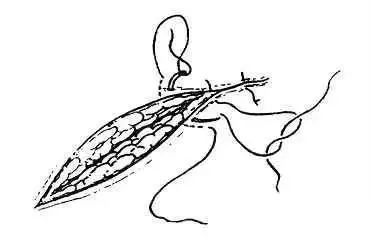 外科8种缝合方法图解,外科基本缝合方法实验报告