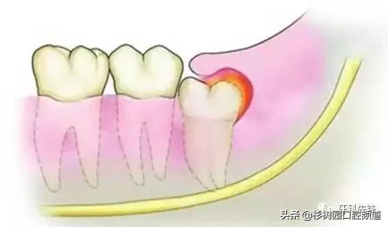牙疼的滋味没人能理解,牙疼的痛苦有谁能够体会