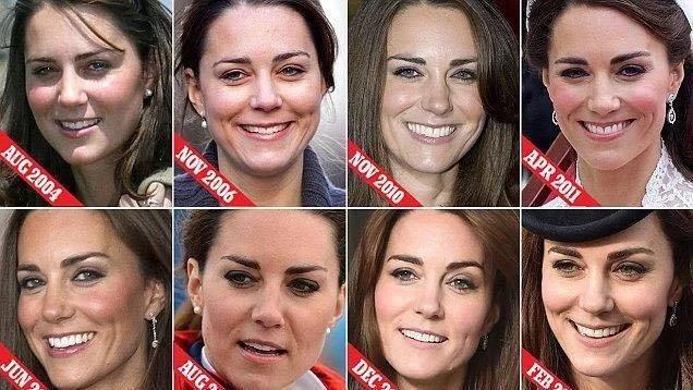 凯特王妃整形了吗,王妃凯特有没有整容