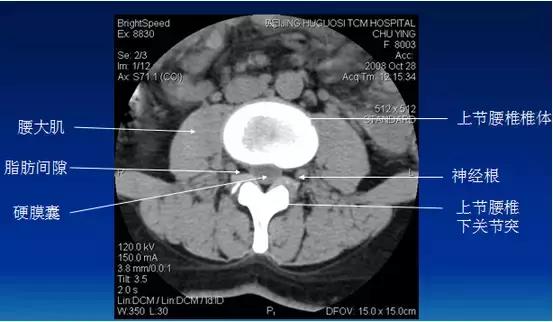 腰椎退行性变腰椎间盘轻度突出,椎间盘突出并膨出继发椎管狭窄
