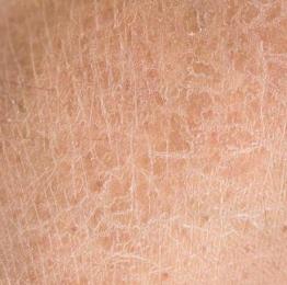 腿上有鱼鳞片皮肤病,腿上出现像鱼鳞是怎么回事