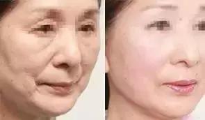 线雕加玻尿酸可以保多长时间,玻尿酸加线雕隆鼻能半永久吗