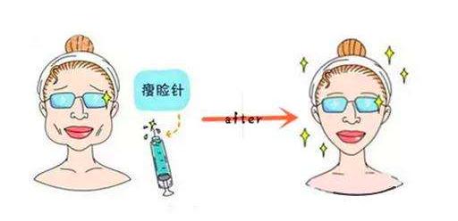 瘦脸针自己怎么打咬肌,武汉协和医院打瘦脸针效果怎么样