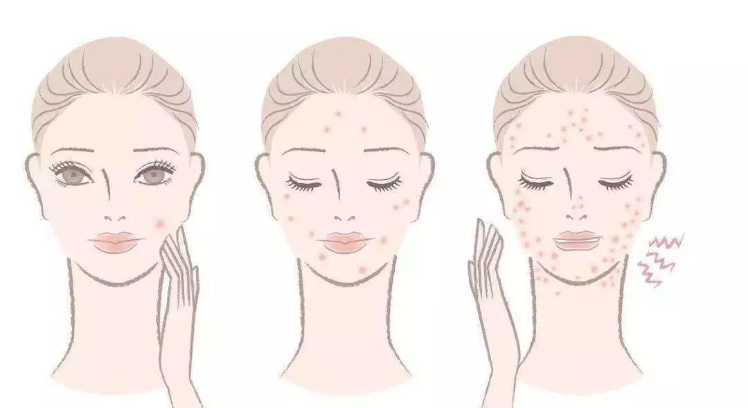 你知道什么是激素脸吗