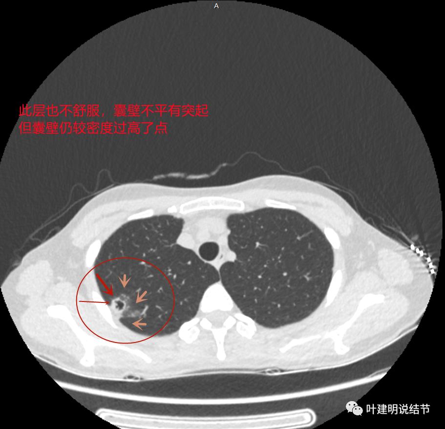 临床诊断孤立性肺结节,空洞型结节一般是什么性质