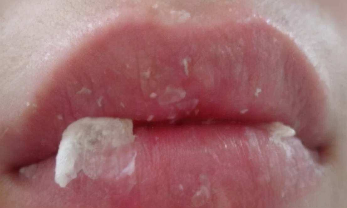 嘴唇脱皮干裂无法涂口红,嘴唇脱皮不干燥是什么原因引起的