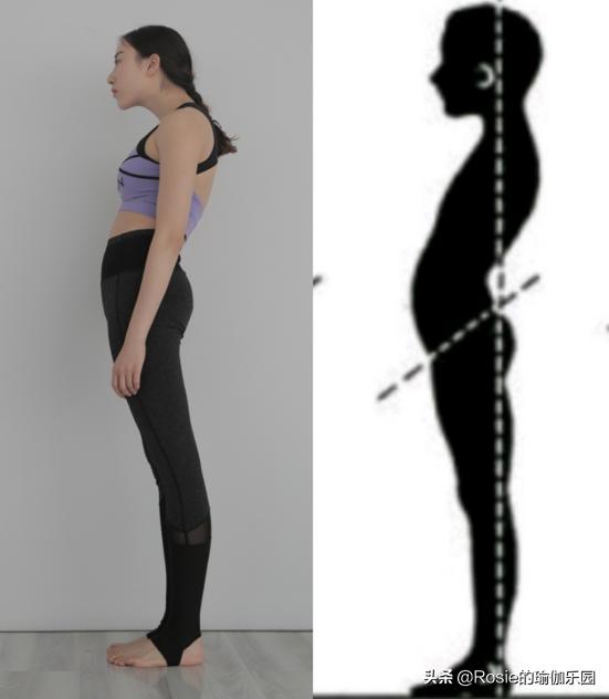 富贵包快速消除背部方法,为什么背有富贵包