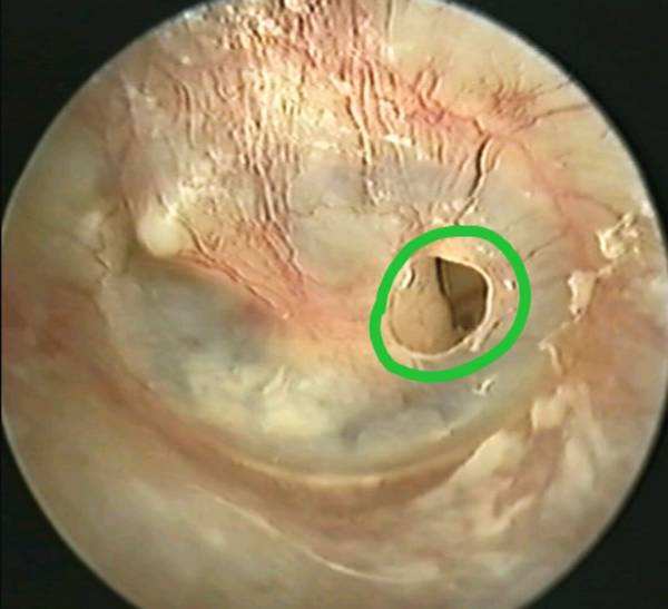 耳屎堵得很厉害需要掏出来吗,耳朵深处的耳屎有必要全掏干净吗
