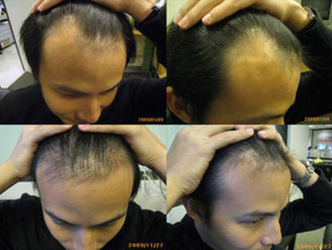 孙协志脱发,孙协志老了