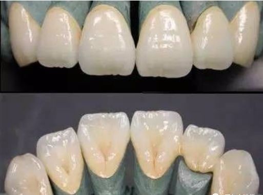 牙齿做完根管治疗要戴牙套吗,根管治疗后树脂填充还是戴牙冠好