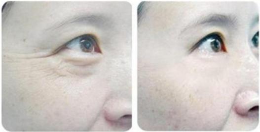 眼部细纹黑眼圈泪沟显老怎么办,眼部有皱纹怎么能去除皱纹