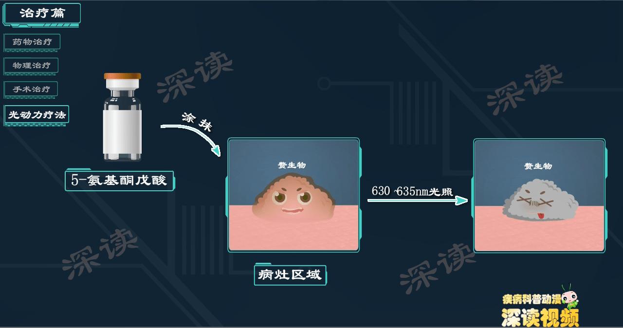 液氮冷冻治疗尖锐湿疣没感觉,液氮冷冻治疗尖锐湿疣注意事项