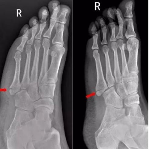 怎样发现骨折的可能性,一招看出手指骨折