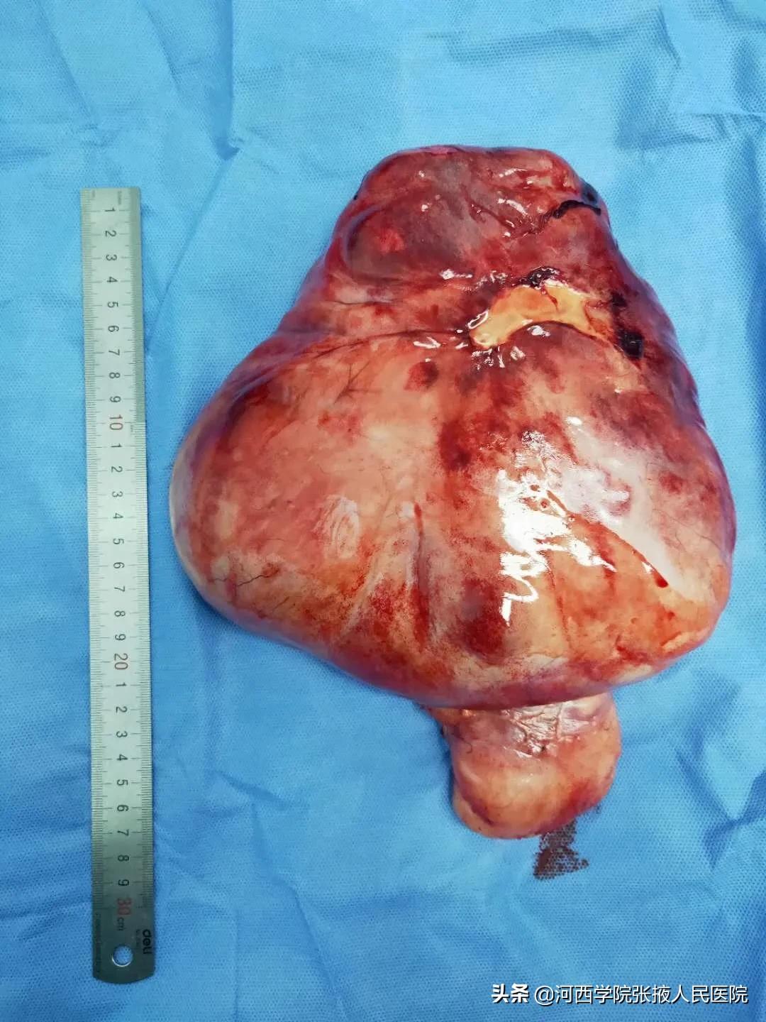 80多岁腹膜后肿瘤,高龄腹腔良性肿瘤手术风险