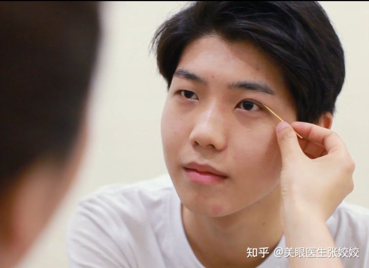 男生双眼皮手术前后对比,男生做双眼皮手术的效果