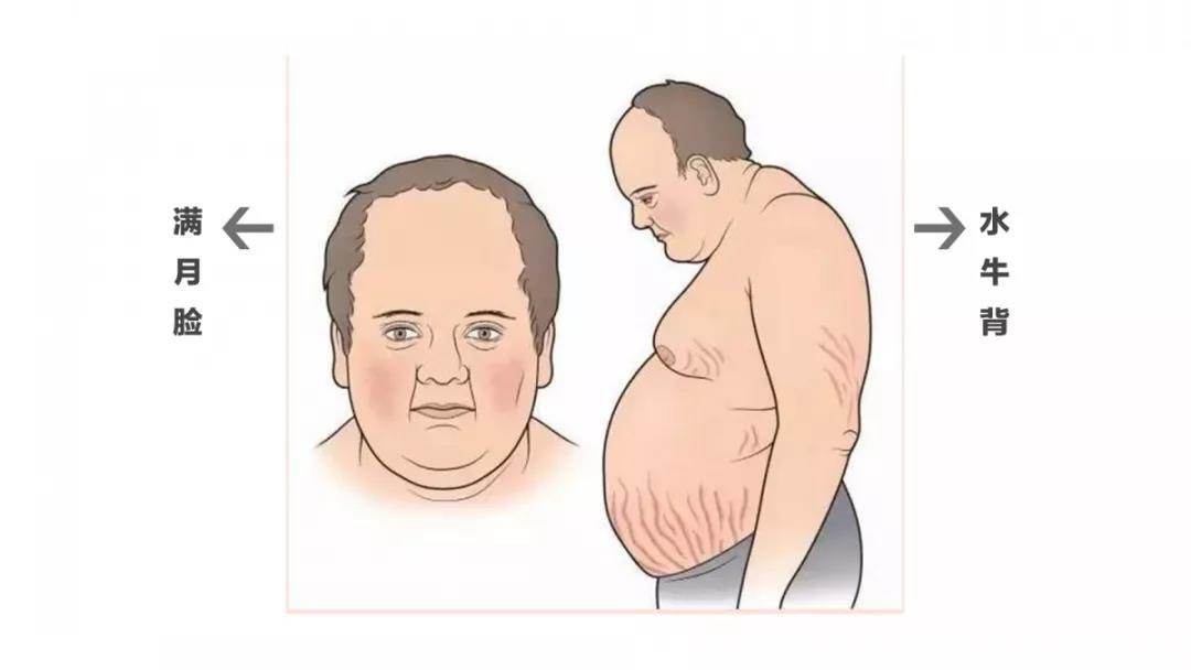 成也激素,败也激素:类风湿治疗中,如何避开激素带来的“陷阱”