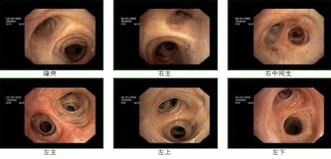 新冠症状容易与常见疾病症状混淆,症状和新冠一样怎么办