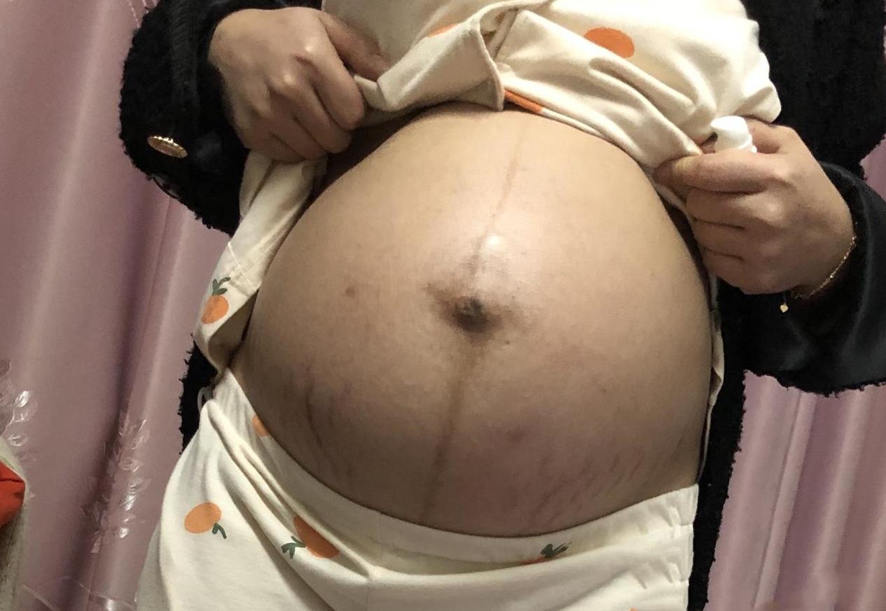 耻骨痛的孕妇会不会好生些,耻骨痛是每个孕妇都会经历的吗