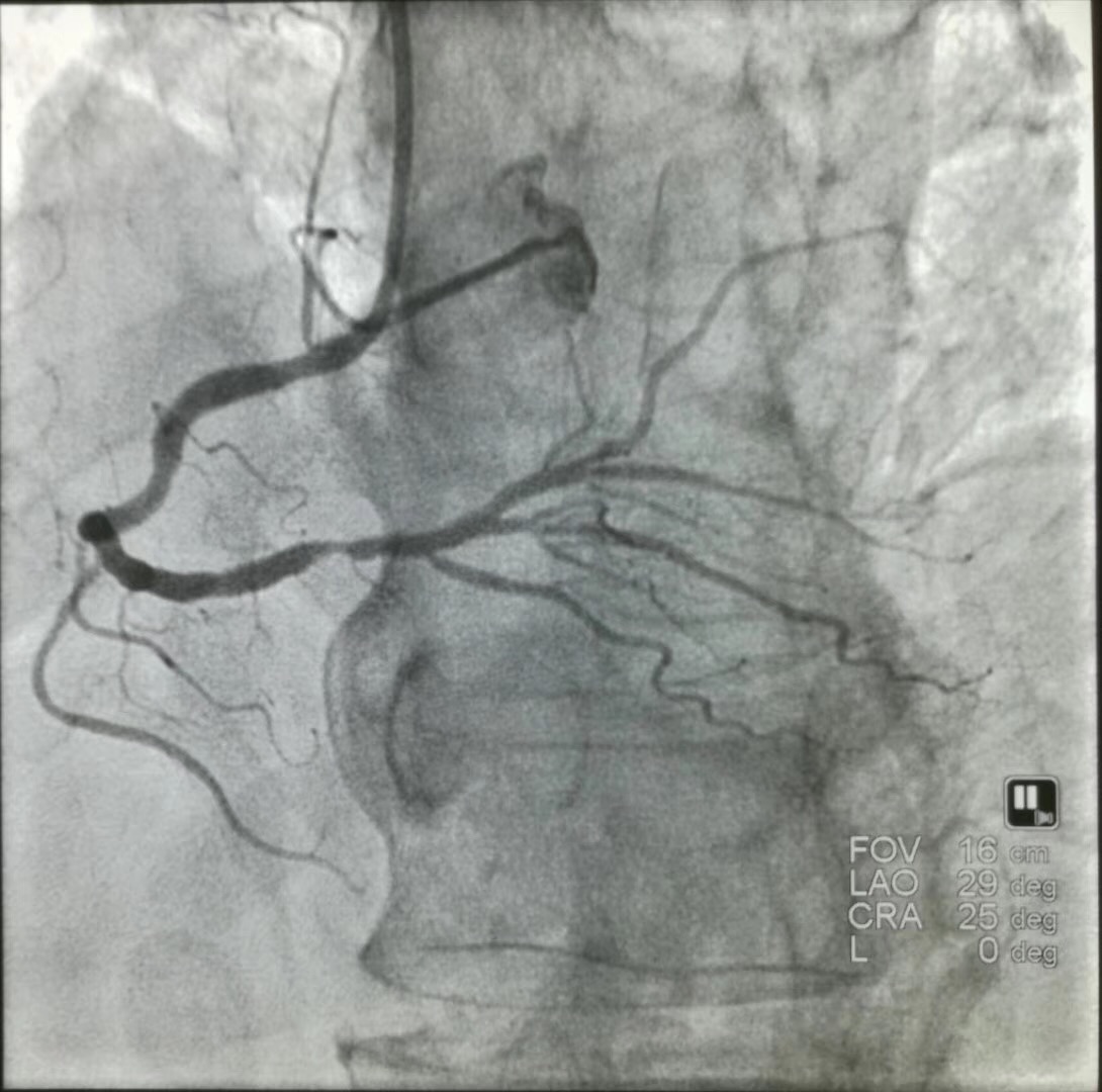超声能查出心脏病吗,超声冠心病