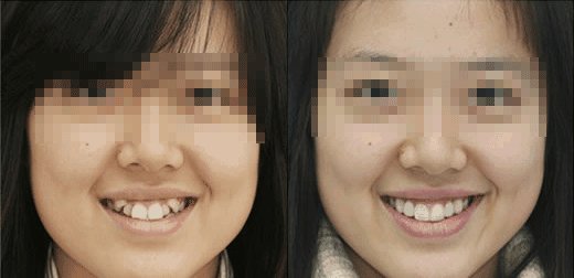 “*牙虎**这么多余,可以拔了吗?”看看明星你就知道答案了