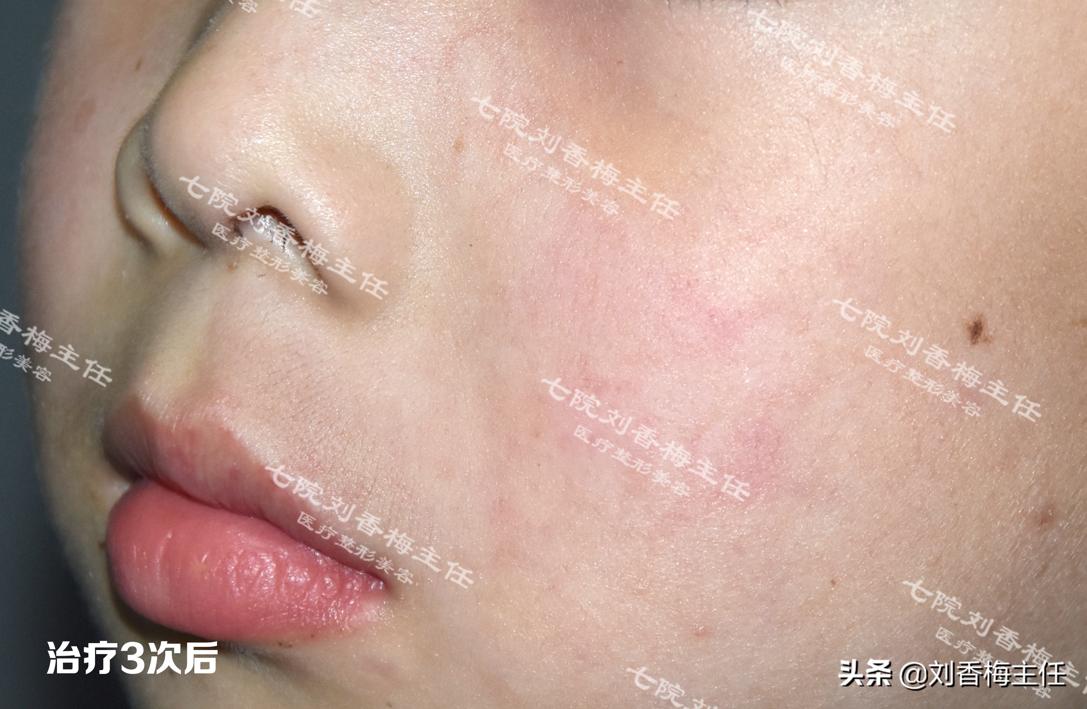 脉冲染料激光治疗鲜红斑痣治愈率,脉冲染料激光治鲜红斑痣效果