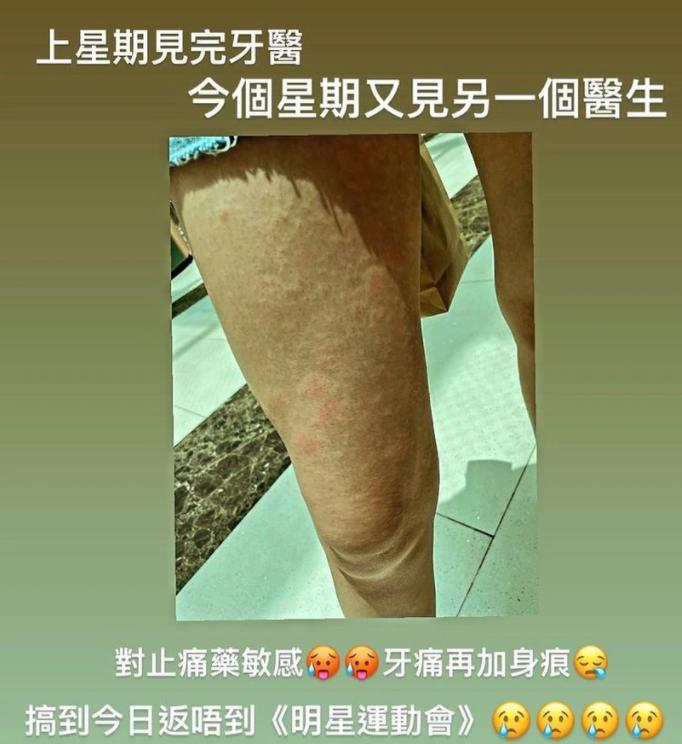 26岁女星江嘉敏拔牙后药物过敏，导致全身瘙痒，腿上长满小疙瘩