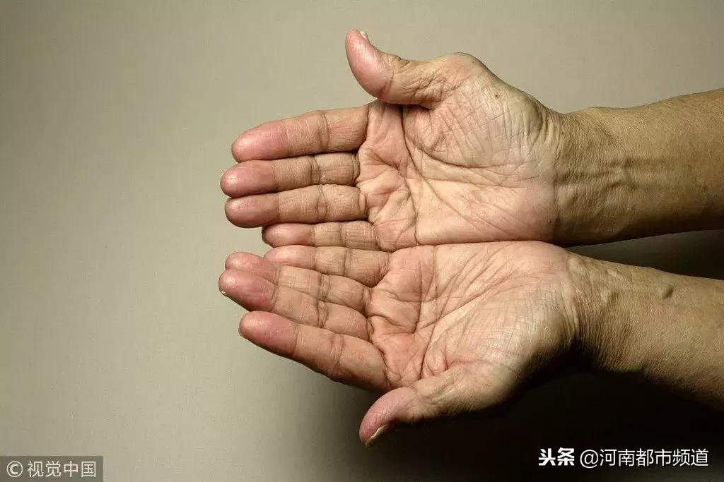 妈妈证,手指上的指纹不见了怎么办